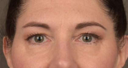 Blepharoplasty Before & After Patient #3128