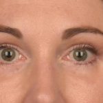 Blepharoplasty Before & After Patient #3128
