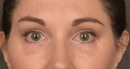 Blepharoplasty Before & After Patient #3128