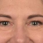Blepharoplasty Before & After Patient #3128