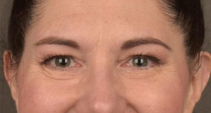Blepharoplasty Before & After Patient #3128