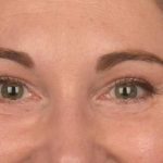 Blepharoplasty Before & After Patient #3128