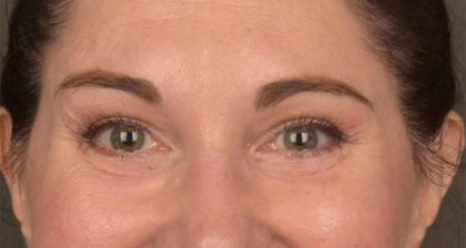 Blepharoplasty Before & After Patient #3128