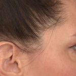 Blepharoplasty Before & After Patient #3128