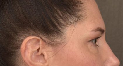 Blepharoplasty Before & After Patient #3128