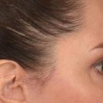 Blepharoplasty Before & After Patient #3128