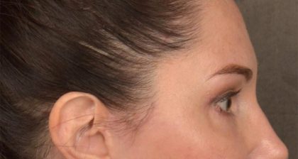 Blepharoplasty Before & After Patient #3128