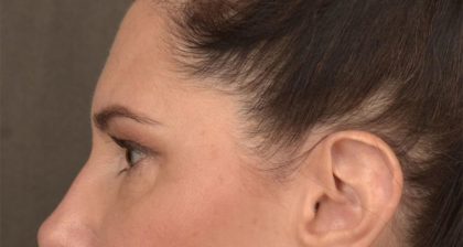 Blepharoplasty Before & After Patient #3128