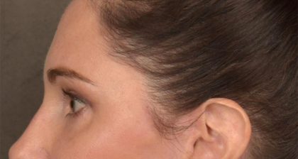 Blepharoplasty Before & After Patient #3128