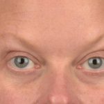 Blepharoplasty Before & After Patient #3129