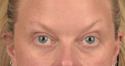 Blepharoplasty Before & After Patient #3129
