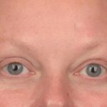 Blepharoplasty Before & After Patient #3129