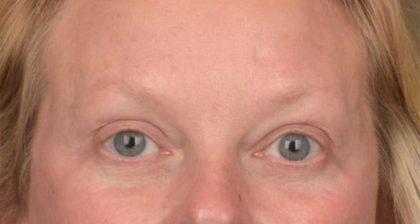 Blepharoplasty Before & After Patient #3129