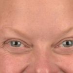 Blepharoplasty Before & After Patient #3129