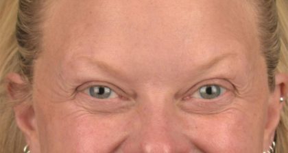 Blepharoplasty Before & After Patient #3129