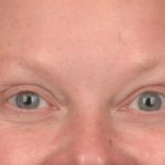 Blepharoplasty Before & After Patient #3129