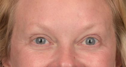 Blepharoplasty Before & After Patient #3129