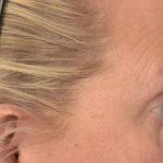 Blepharoplasty Before & After Patient #3129