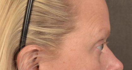 Blepharoplasty Before & After Patient #3129