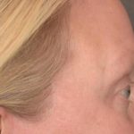 Blepharoplasty Before & After Patient #3129