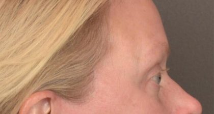 Blepharoplasty Before & After Patient #3129