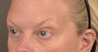 Blepharoplasty Before & After Patient #3129