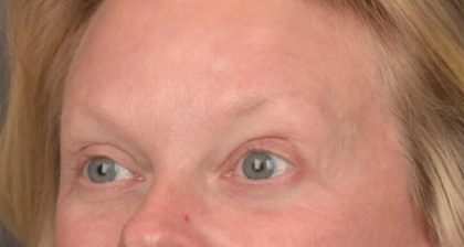Blepharoplasty Before & After Patient #3129