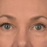 Blepharoplasty Before & After Patient #3130