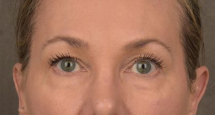 Blepharoplasty Before & After Patient #3130
