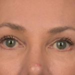 Blepharoplasty Before & After Patient #3130