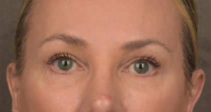 Blepharoplasty Before & After Patient #3130