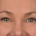 Blepharoplasty Before & After Patient #3130