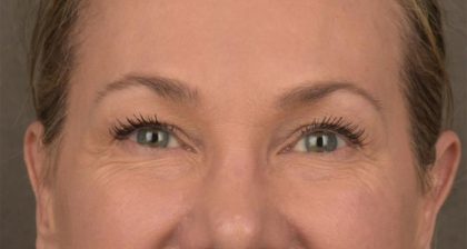 Blepharoplasty Before & After Patient #3130