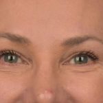 Blepharoplasty Before & After Patient #3130