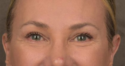 Blepharoplasty Before & After Patient #3130