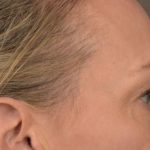 Blepharoplasty Before & After Patient #3130