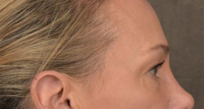 Blepharoplasty Before & After Patient #3130