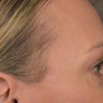 Blepharoplasty Before & After Patient #3130