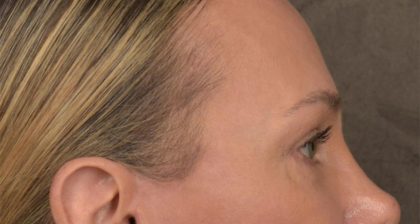 Blepharoplasty Before & After Patient #3130