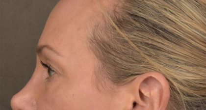 Blepharoplasty Before & After Patient #3130