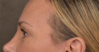Blepharoplasty Before & After Patient #3130