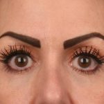 Blepharoplasty Before & After Patient #3131