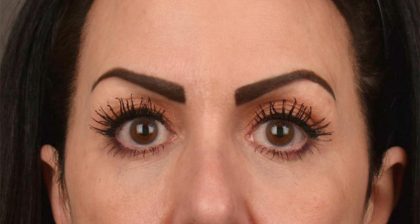 Blepharoplasty Before & After Patient #3131