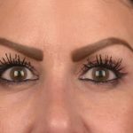 Blepharoplasty Before & After Patient #3131
