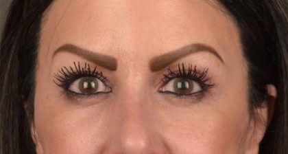 Blepharoplasty Before & After Patient #3131
