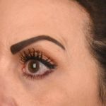 Blepharoplasty Before & After Patient #3131