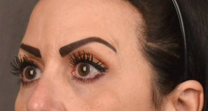 Blepharoplasty Before & After Patient #3131