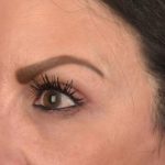Blepharoplasty Before & After Patient #3131