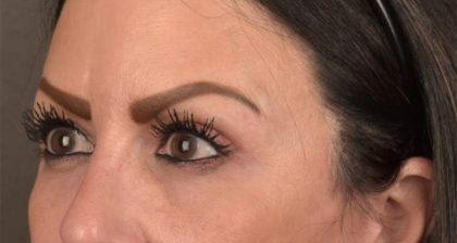 Blepharoplasty Before & After Patient #3131