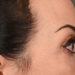 Blepharoplasty Before & After Patient #3131